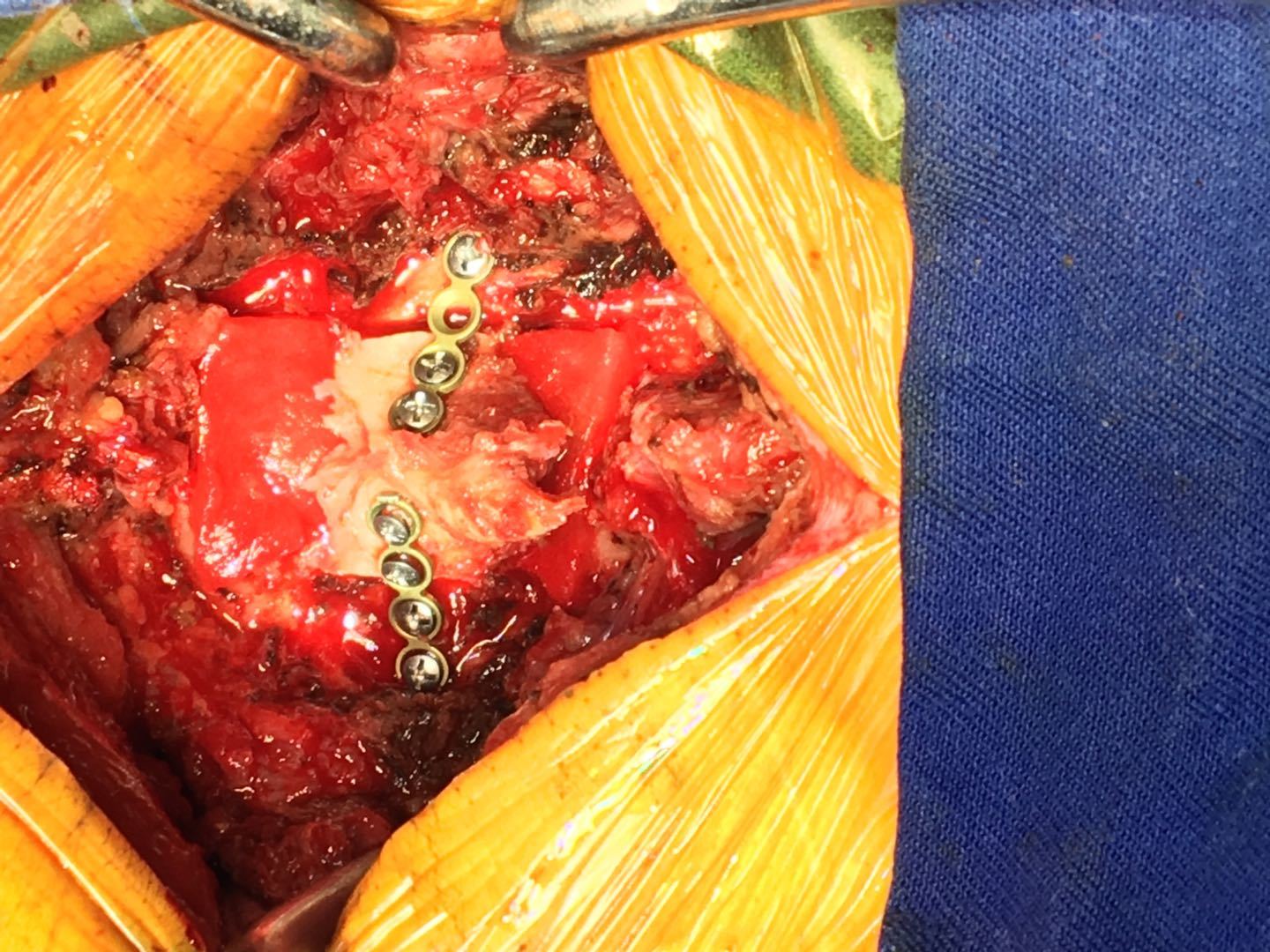 颈椎管内肿瘤手术切除椎板回植技术