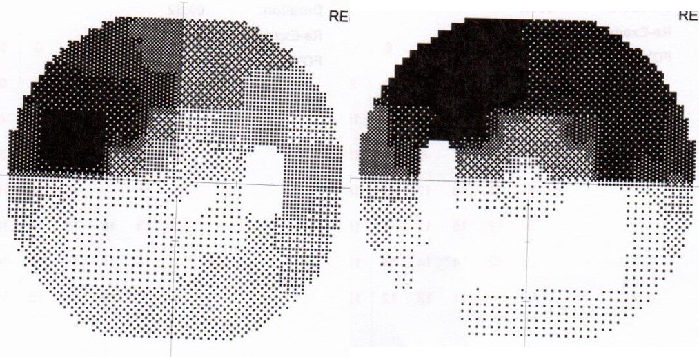 高龄患者得了垂体瘤还能手术吗?