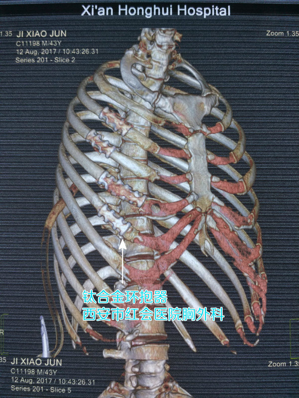 怎么选肋骨骨折固定材料