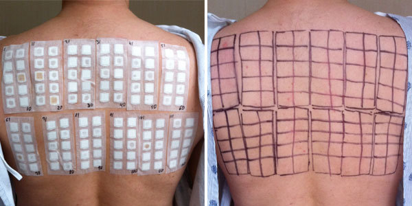 patch test 斑贴试验.jpg