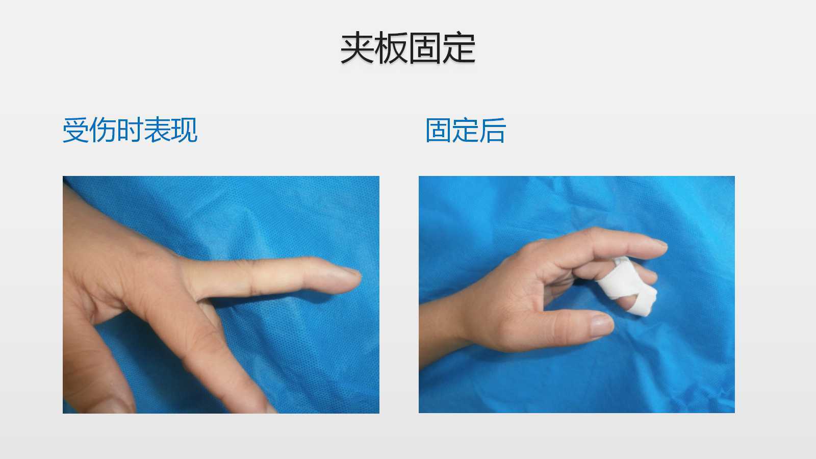 如何治疗锤状指 - 好大夫在线