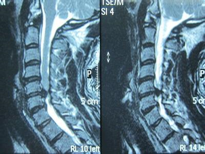 走着走着就走不动了?腰椎管狭窄可能性大。