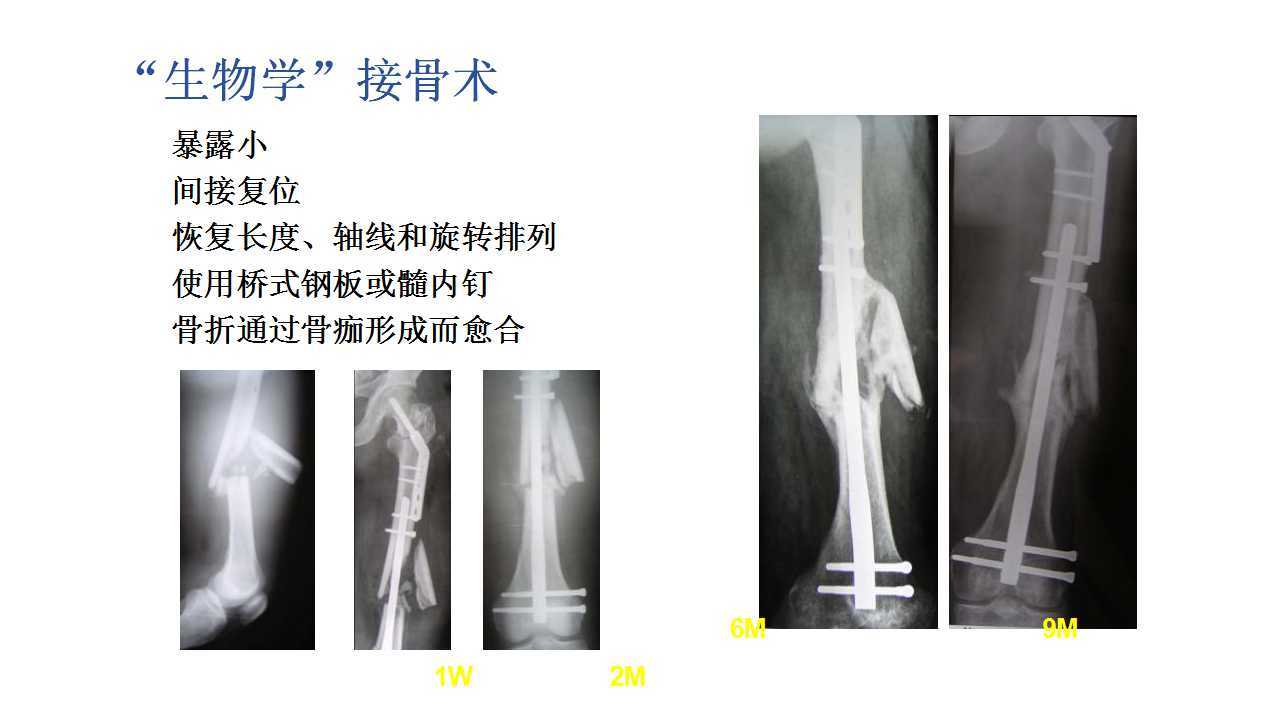 开放性骨折的治疗原则