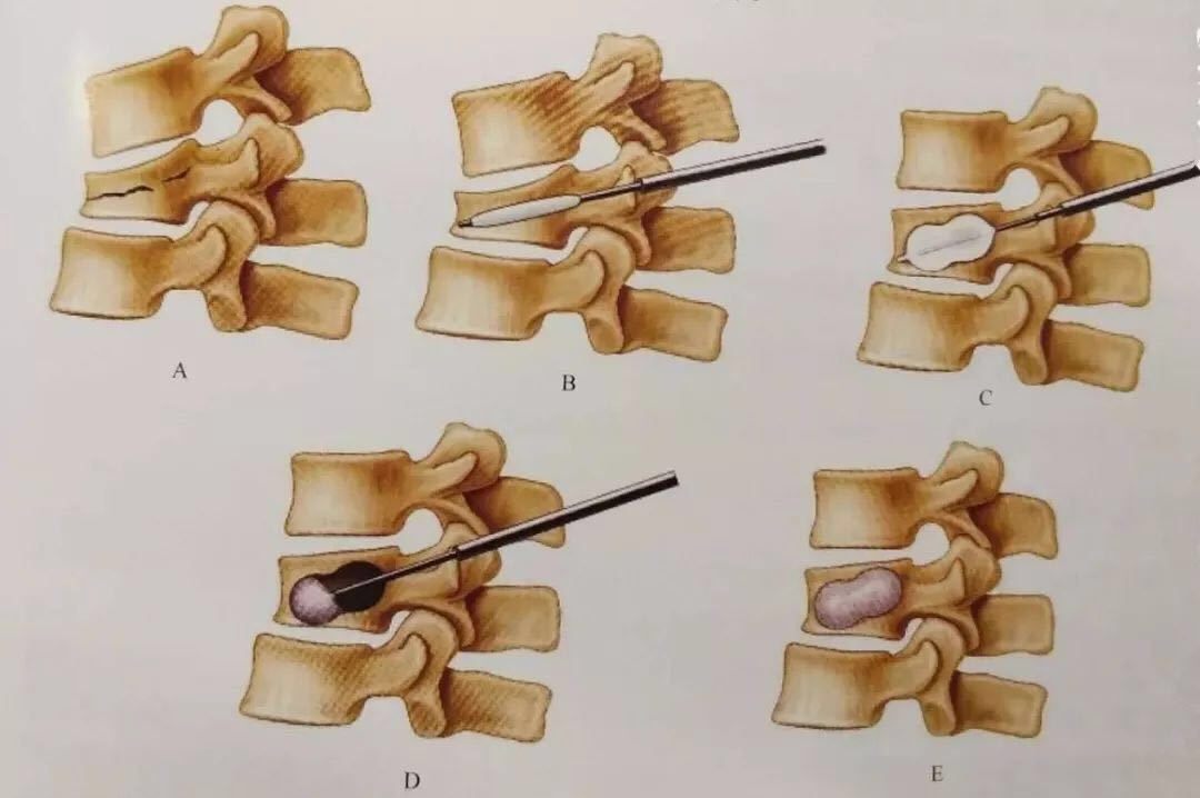 經皮穿刺球囊擴張椎體成形術pkp - 好大夫在線