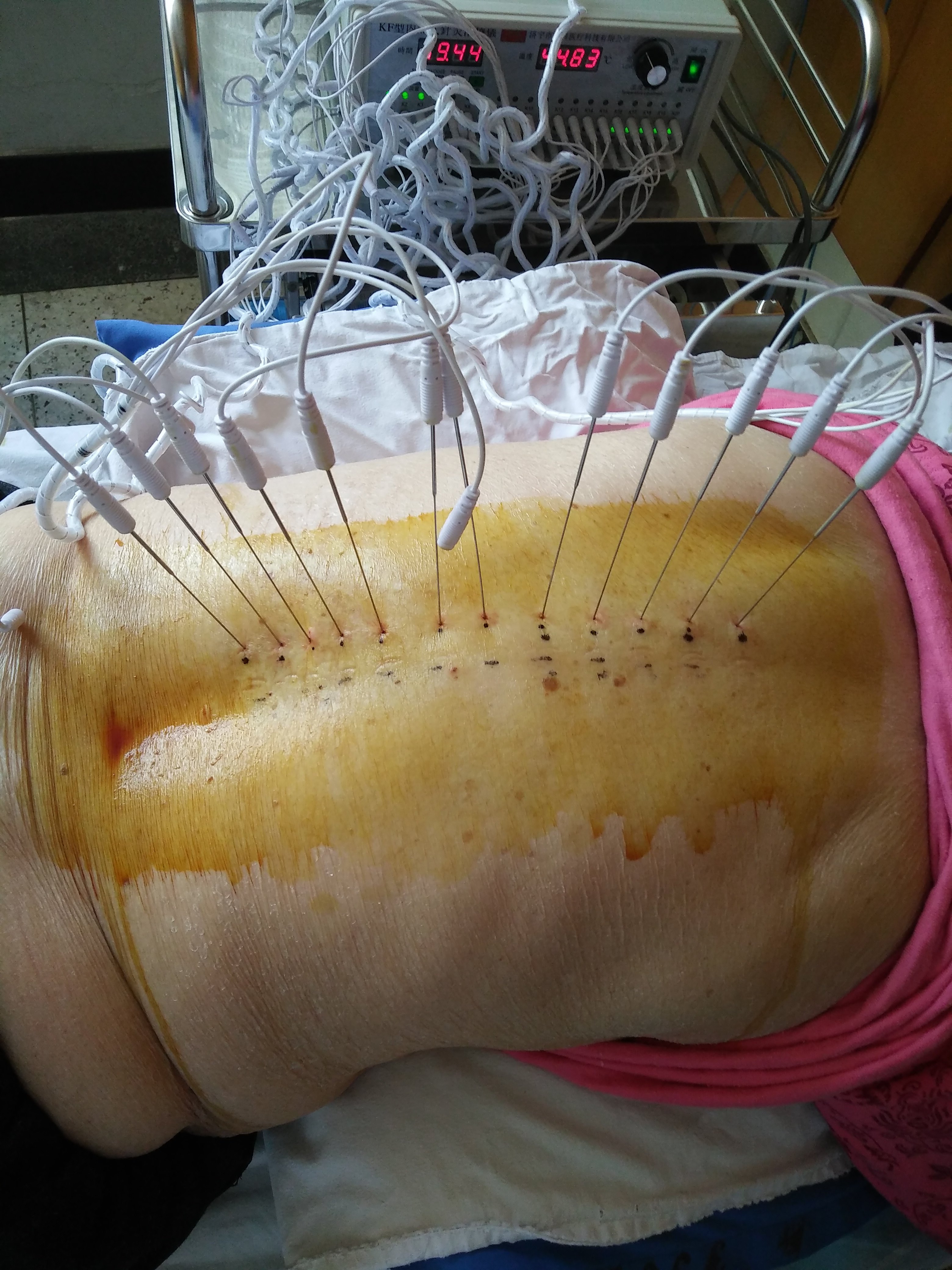 带状疱疹治疗病例 - 好大夫在线