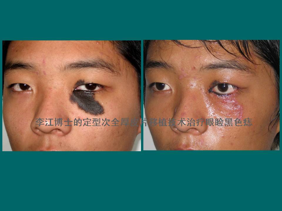 眼睑分裂痣的精准治疗方法