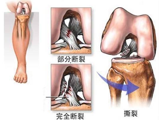 韧带位于膝关节内部,起自股骨外侧髁的内侧面,斜向前下方,止于胫骨