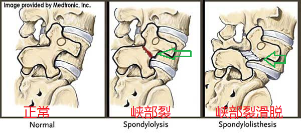 腰椎椎弓峡部图片图片