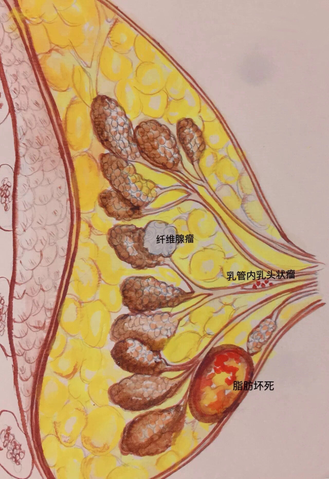 圖解乳腺良性疾病