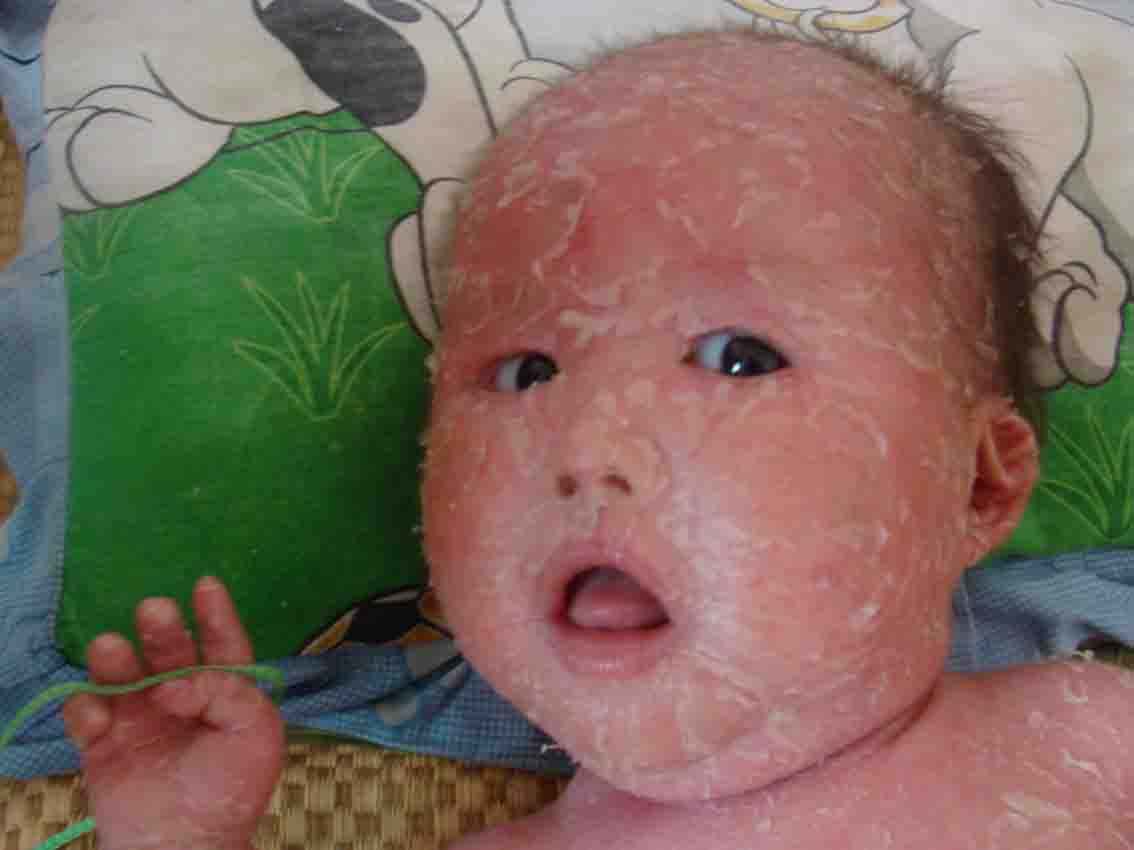小腿上像鱼鳞一样 是什么病 该怎么治疗 小腿上像鱼鳞一样 是什么病 该怎么治疗