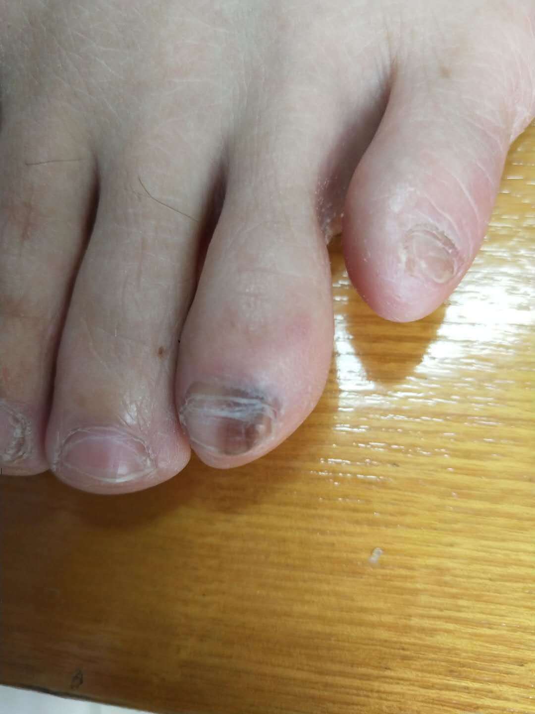 脚指甲黑色素瘤图片