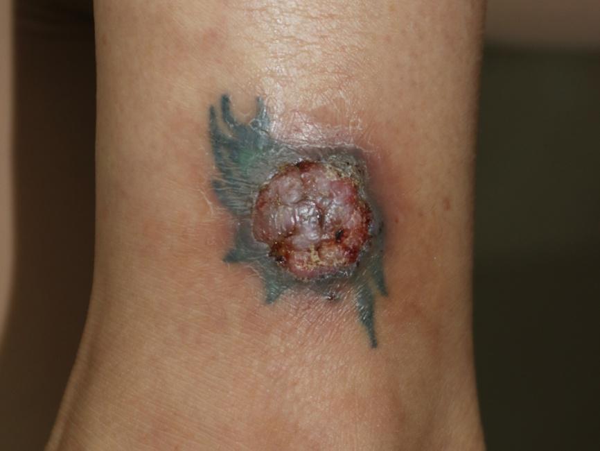 异物纹身肉芽肿 - 好大夫在线