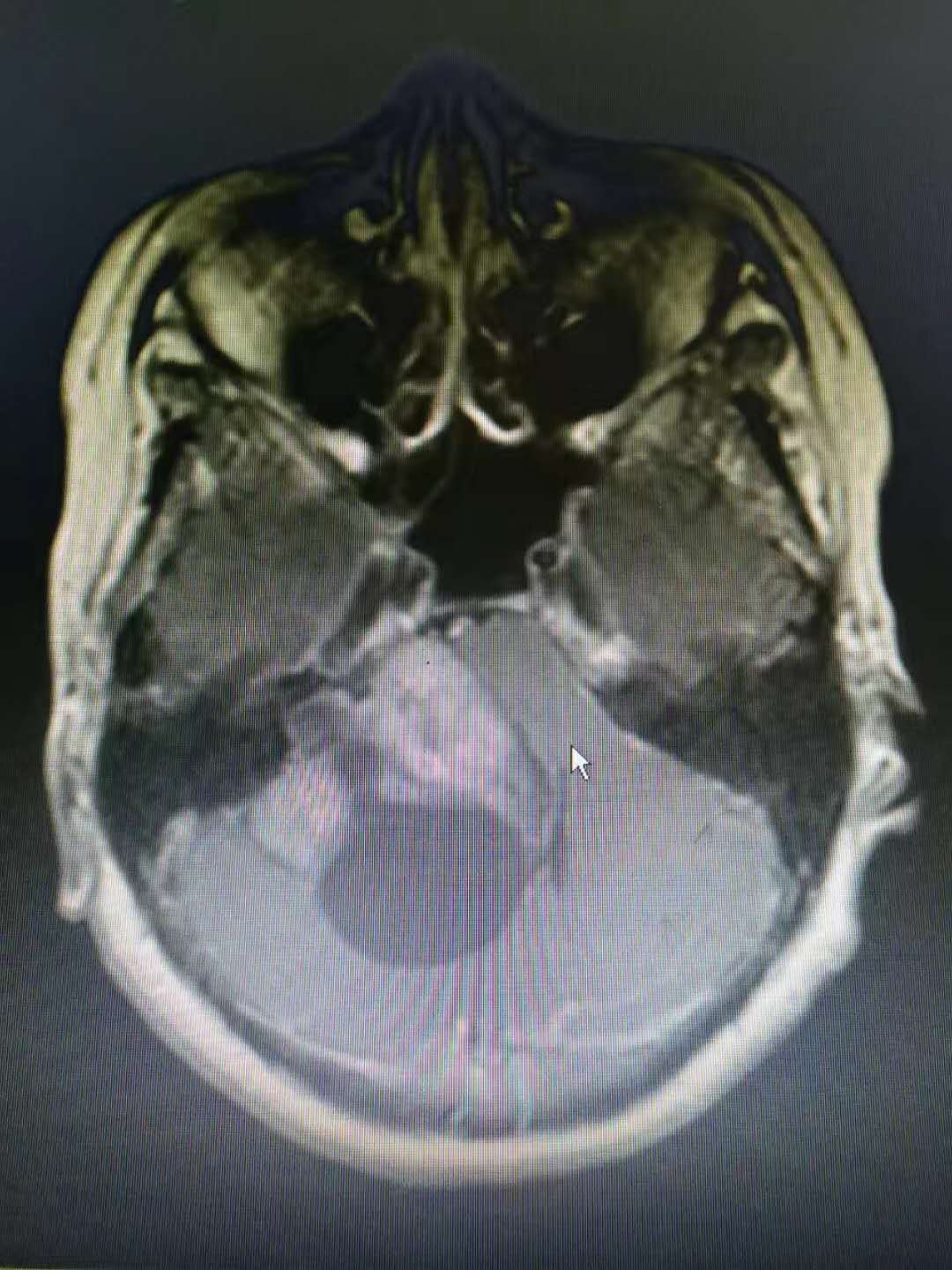 巨大听神经瘤手术 - 好大夫在线