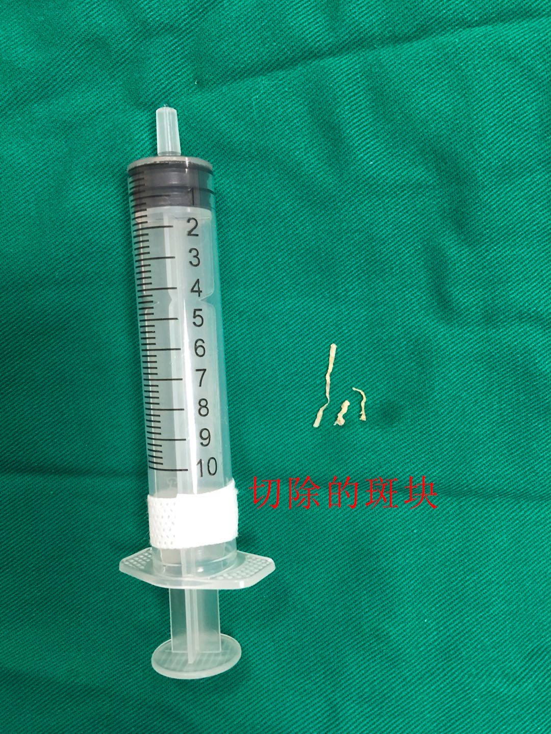 原来动脉内的斑块还可以去掉:斑块旋切技术,还