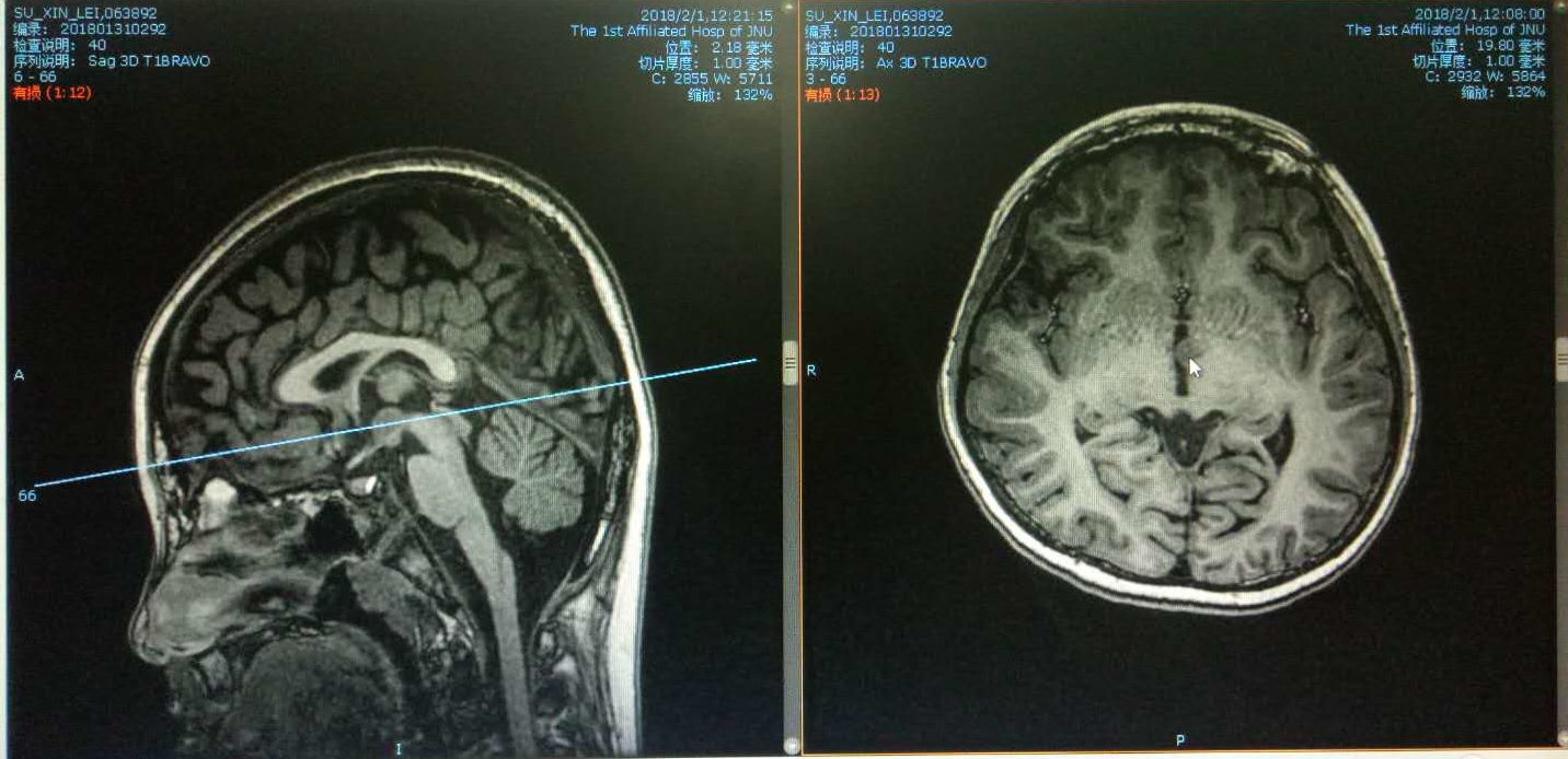 头颅核磁共振可见第三脑室内和侧壁下丘脑错构瘤(左图红色箭头所指