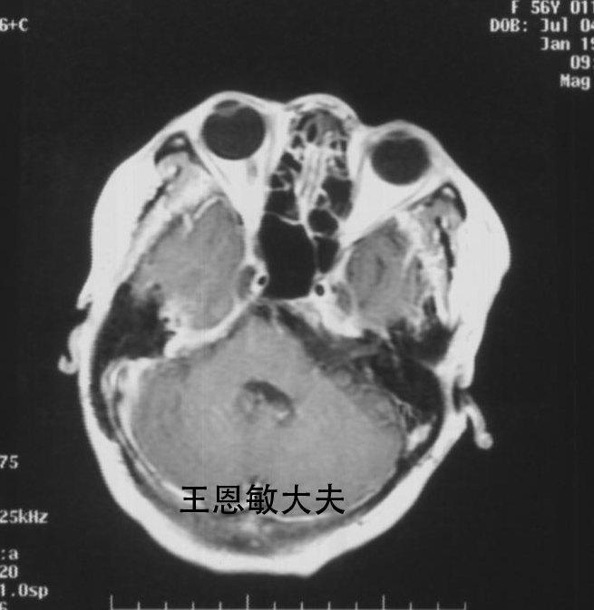 复发听神经瘤的射波刀治疗--每周一例