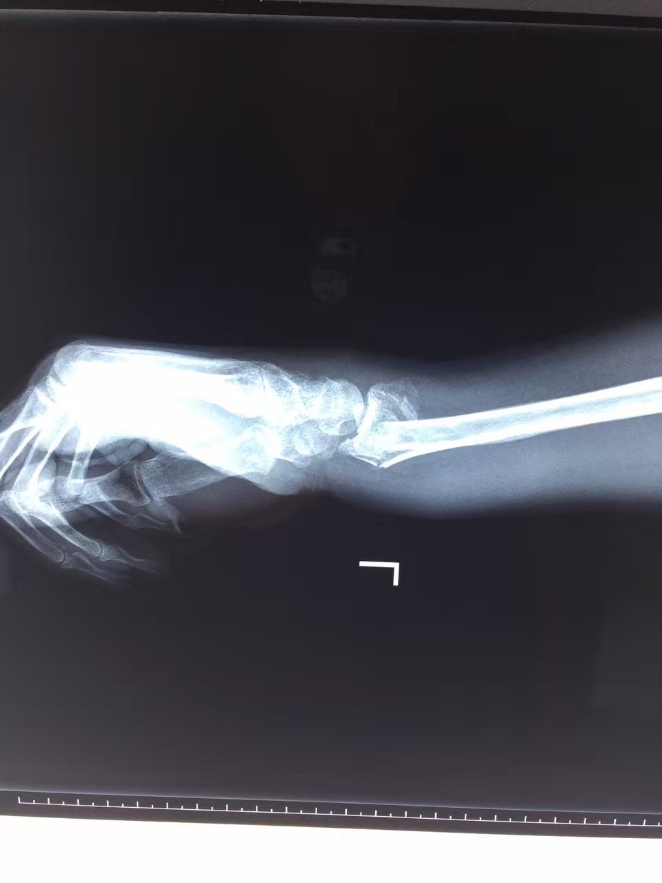 左桡骨远端骨折位置图图片