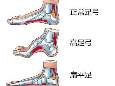2 足部生物力学改变:如扁平足,高弓足,足跟肌腱过短等,长期下来可能因