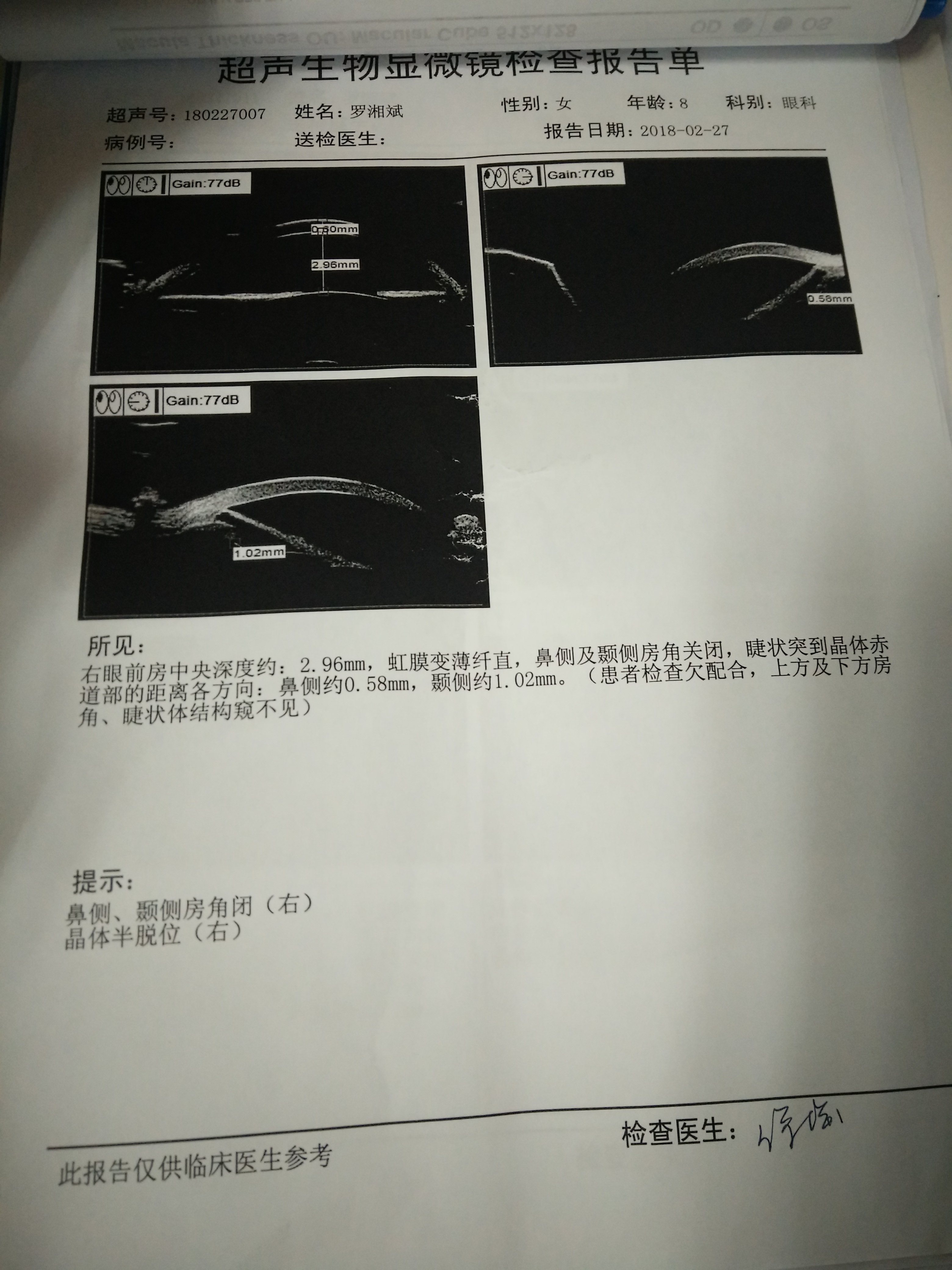 《一》定义:axenfeld-rieger综合征是指双眼发育缺陷,伴或不伴有全身