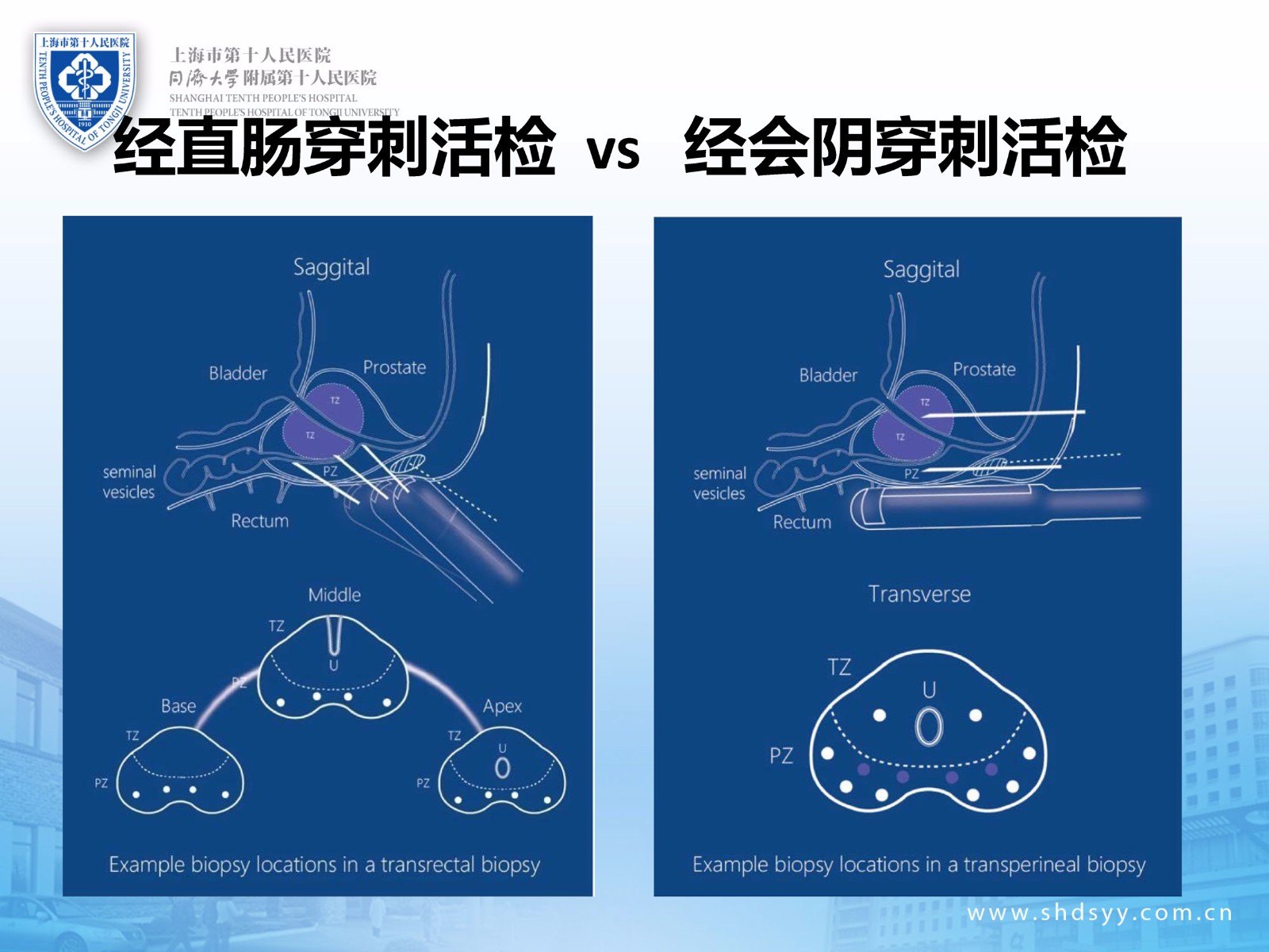 前列腺系统穿刺活检有两种途径(经直肠途径 vs 经会阴途径)