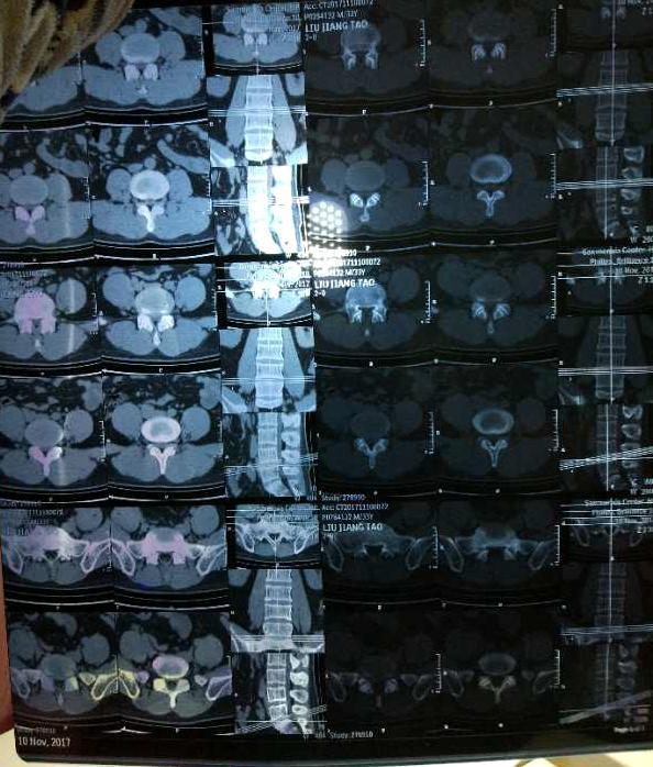 病例:"铁腰板"治疗 - 好大夫在线