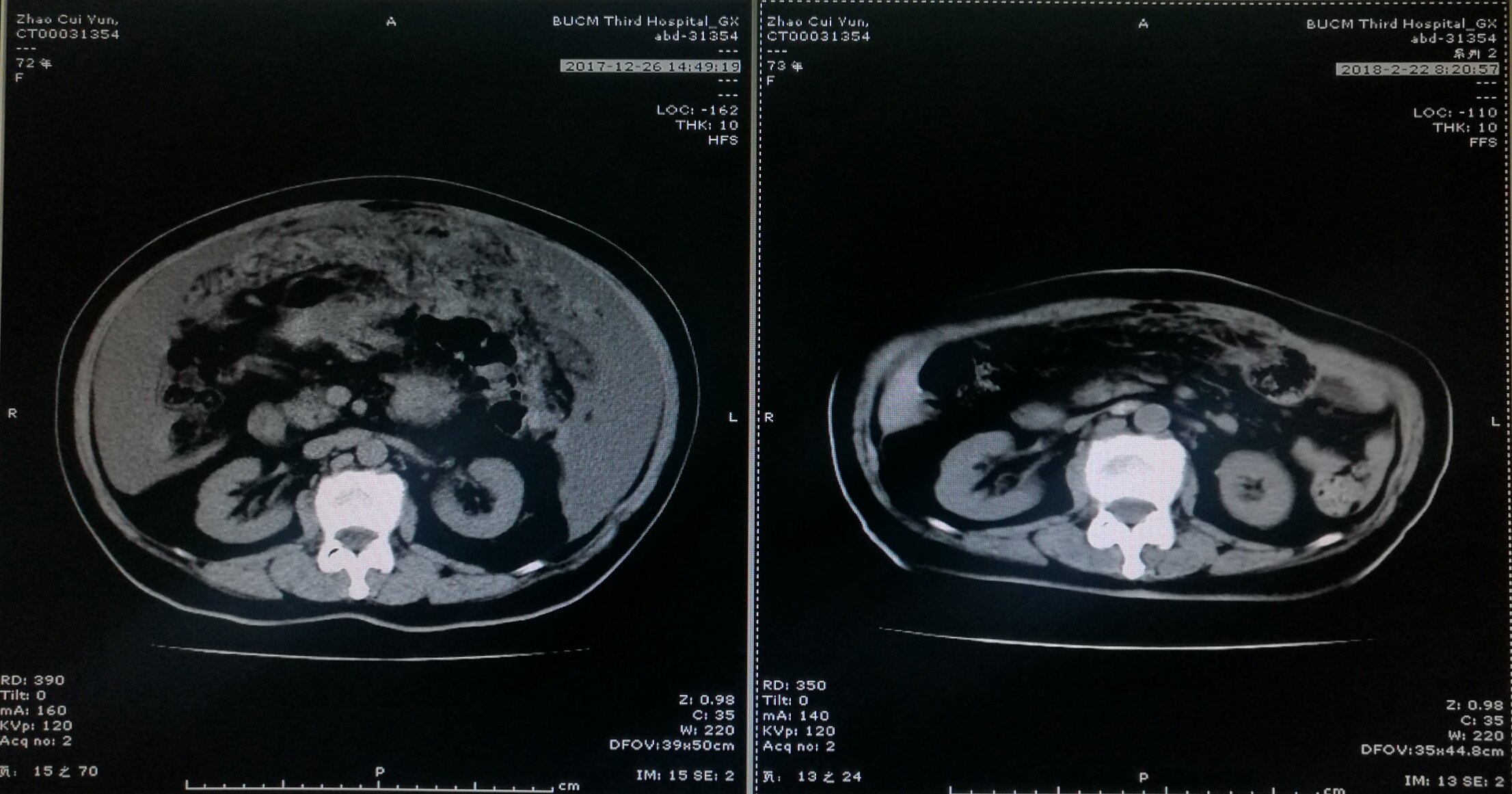 黄金昶中药7剂症状缓解后行ct导引下腹膜转移病灶活检,提示卵巢癌,后