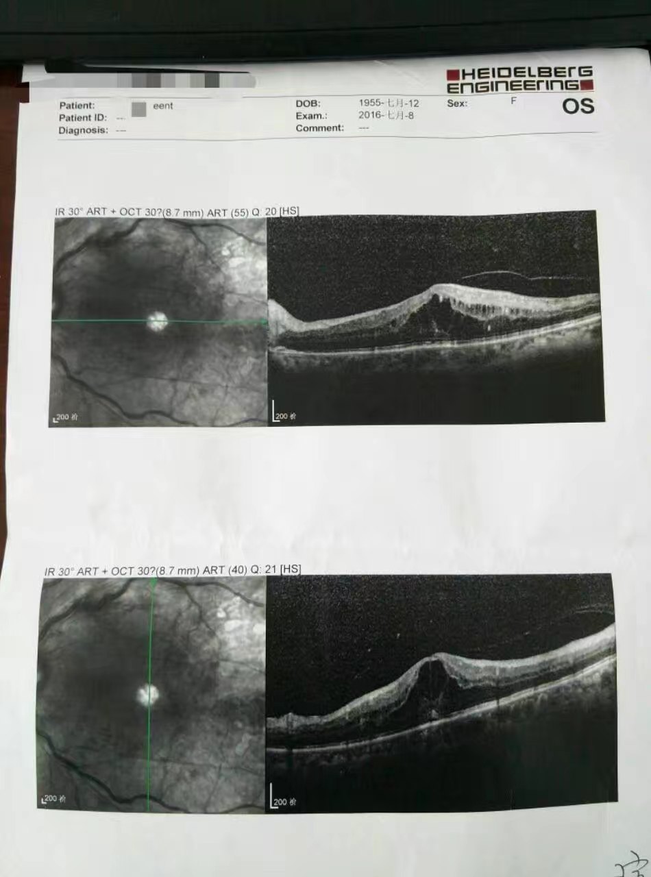 中药治疗糖网 视网膜中央静脉阻塞 黄斑囊样水肿1例 - 好大夫在线