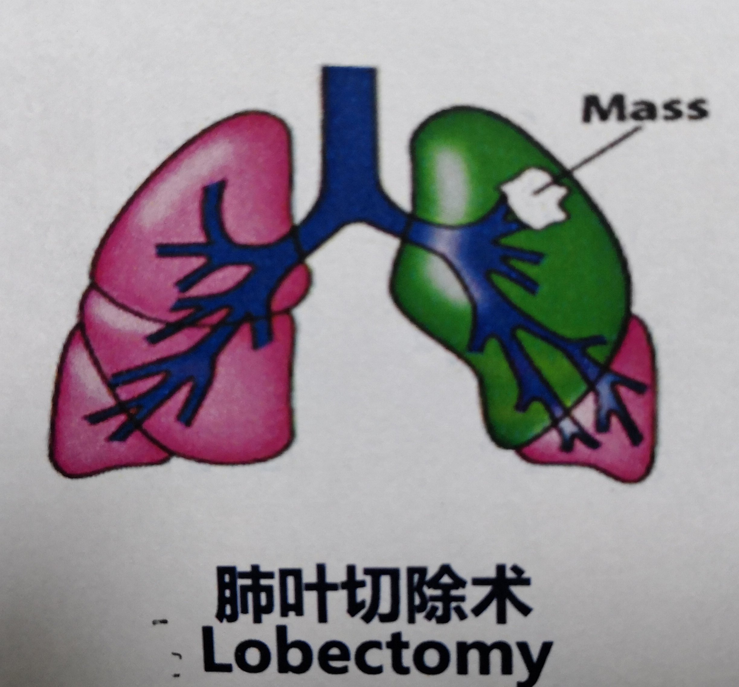 肺袖状切除术示意图图片