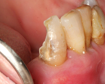 尽量保留自己的残冠一例 - 好大夫在线