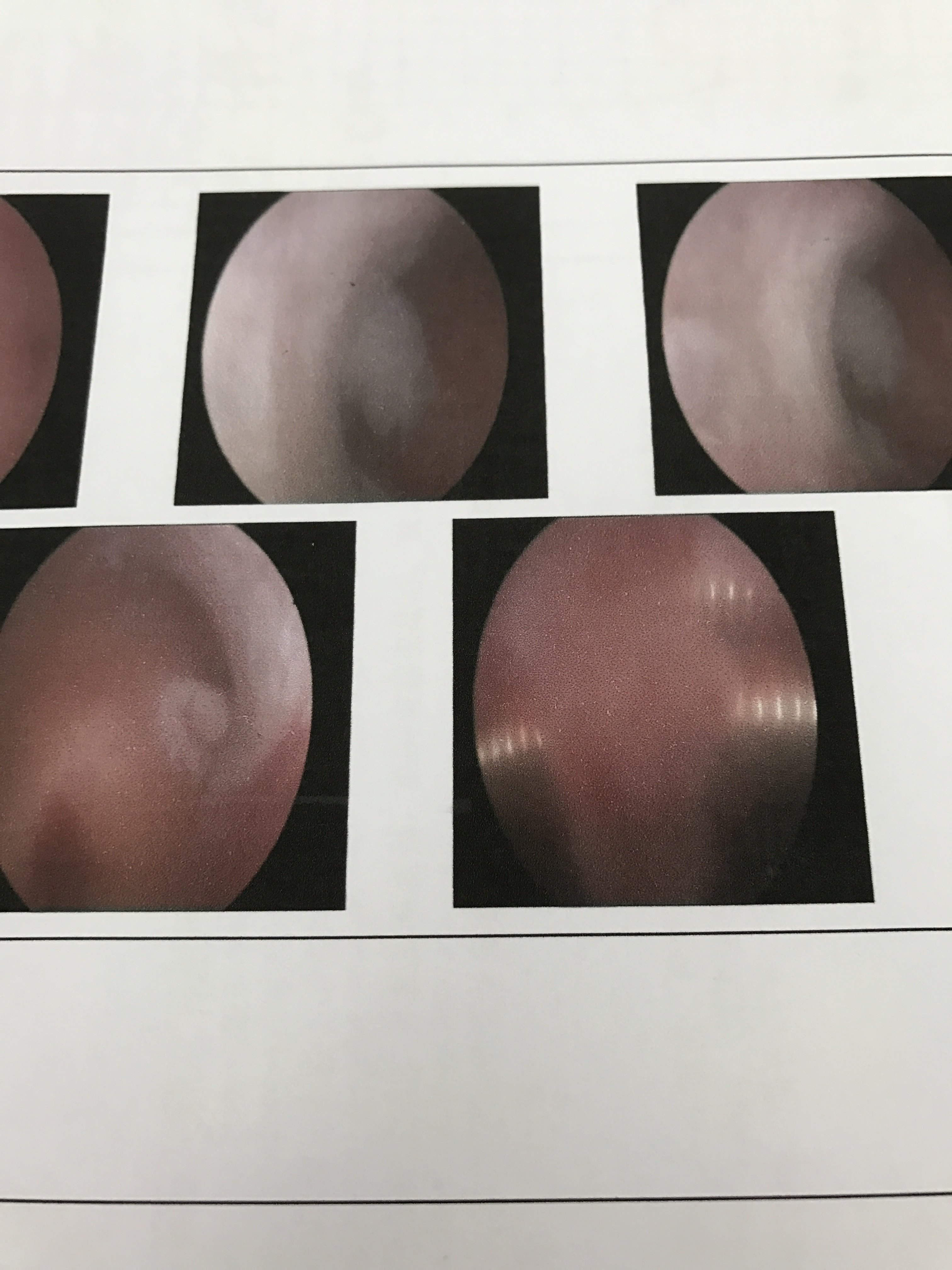 診斷:t型宮腔.宮腔鏡下所見:雙側內聚呈t型,右側明顯.