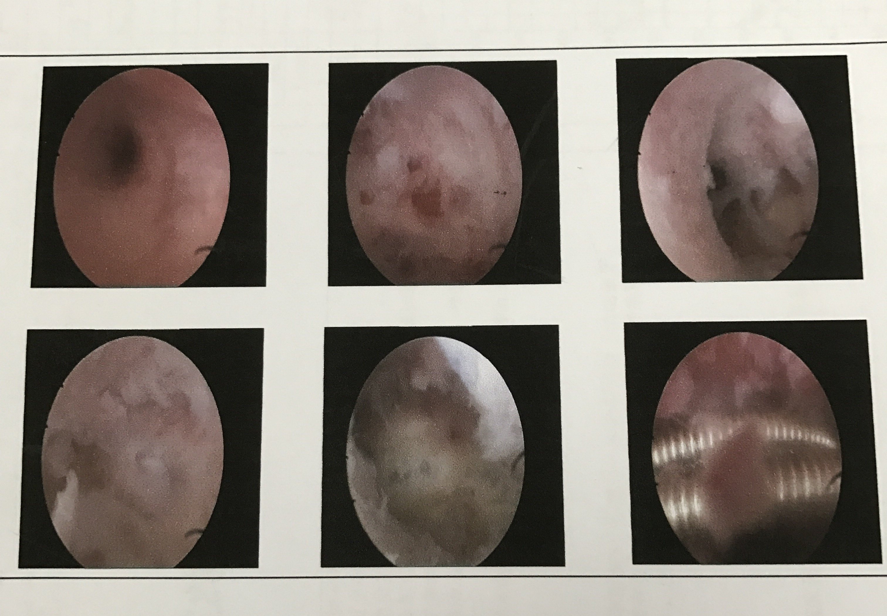 宫腔镜手术后水囊图片图片