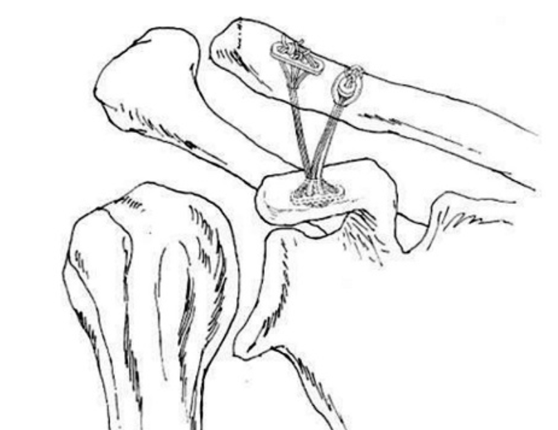 双endobutton钢板重建喙锁韧带治疗肩锁关节脱位的优点:(1)动力稳定