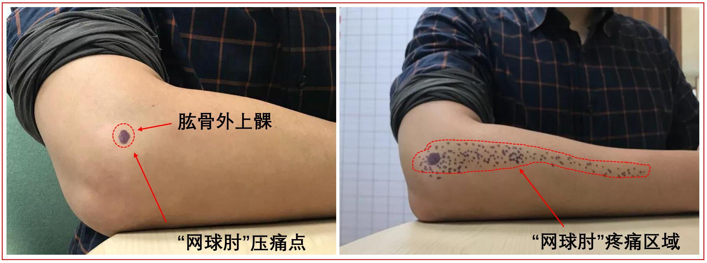 有一种胳膊痛叫 网球肘 网球肘 网球肘疾病介绍 好大夫在线 有一种胳膊痛叫 网球肘 网球肘 网球肘疾病介绍 好大夫在线