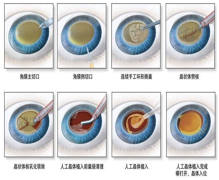 白内障四期分类图片图片