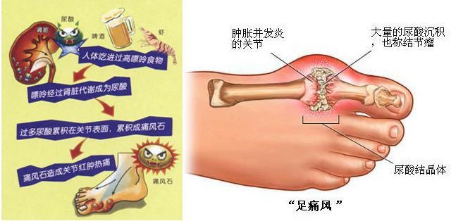 痛風和高尿酸血癥患者血尿酸的起始治療與控制目標