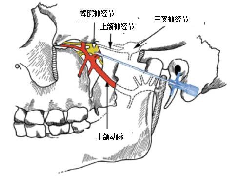 蝶腭神经痛的诊断及微创介入治疗 