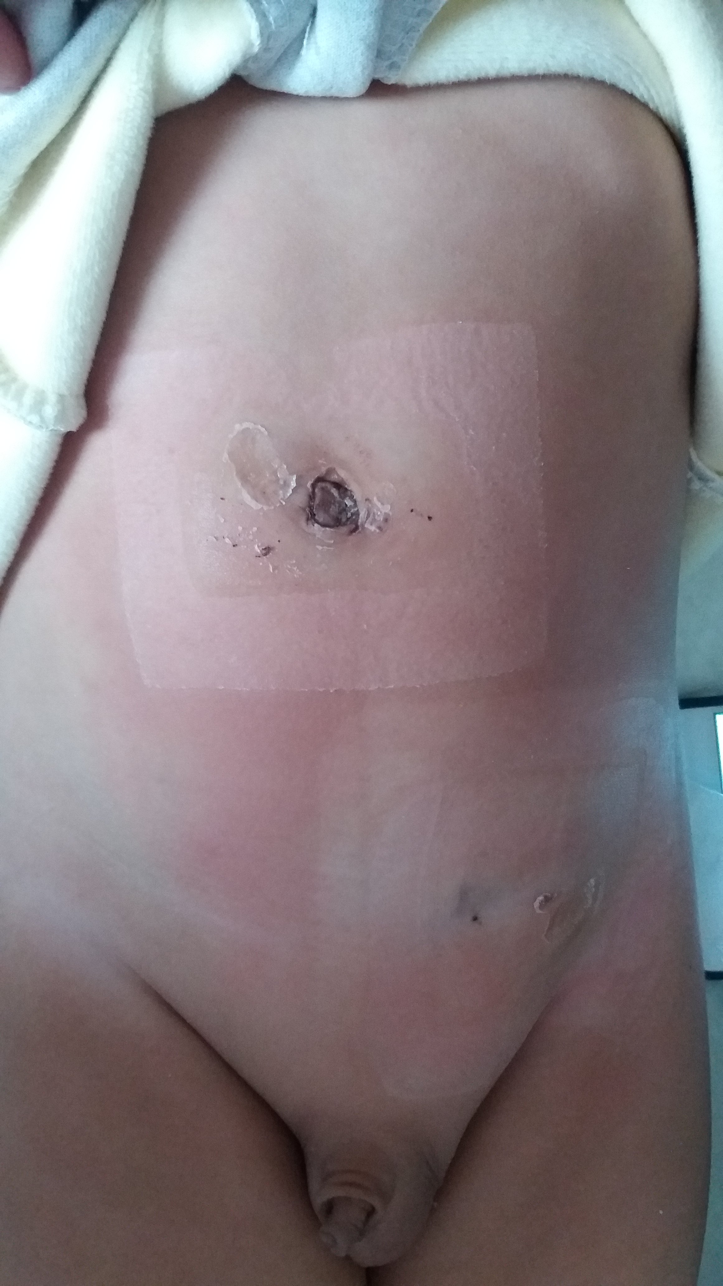 经脐单部位腹腔镜手术治疗小儿疝气、阑尾炎、