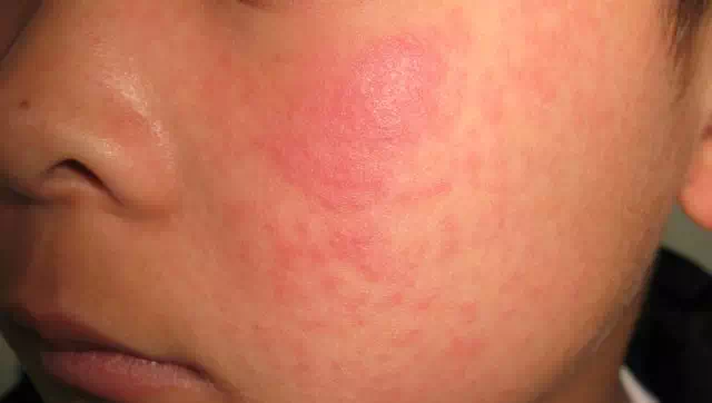 教您识别病毒疹3