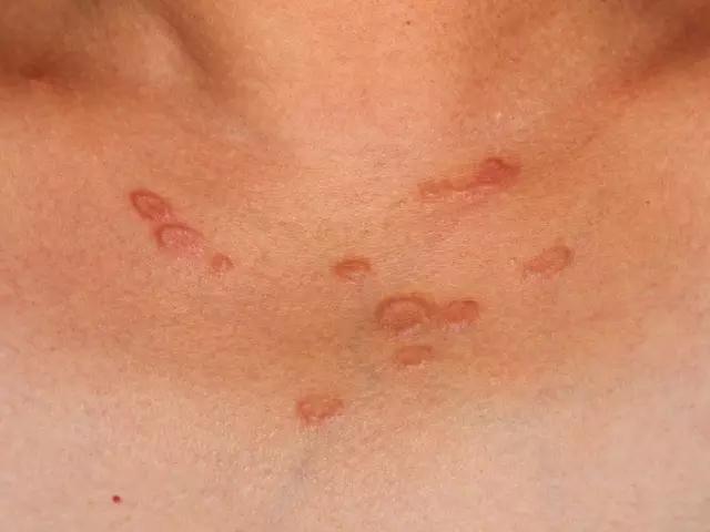 光线性肉芽肿(actinic granuloma) - 好大夫在线