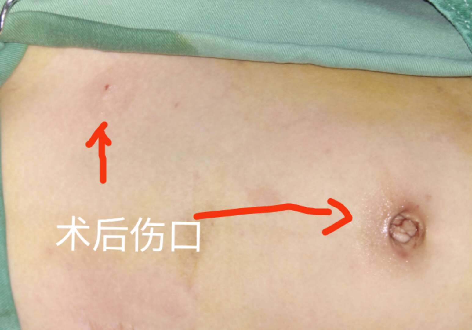 腹腔镜下小儿腹股沟疝气治疗新技术 - 好大夫在线
