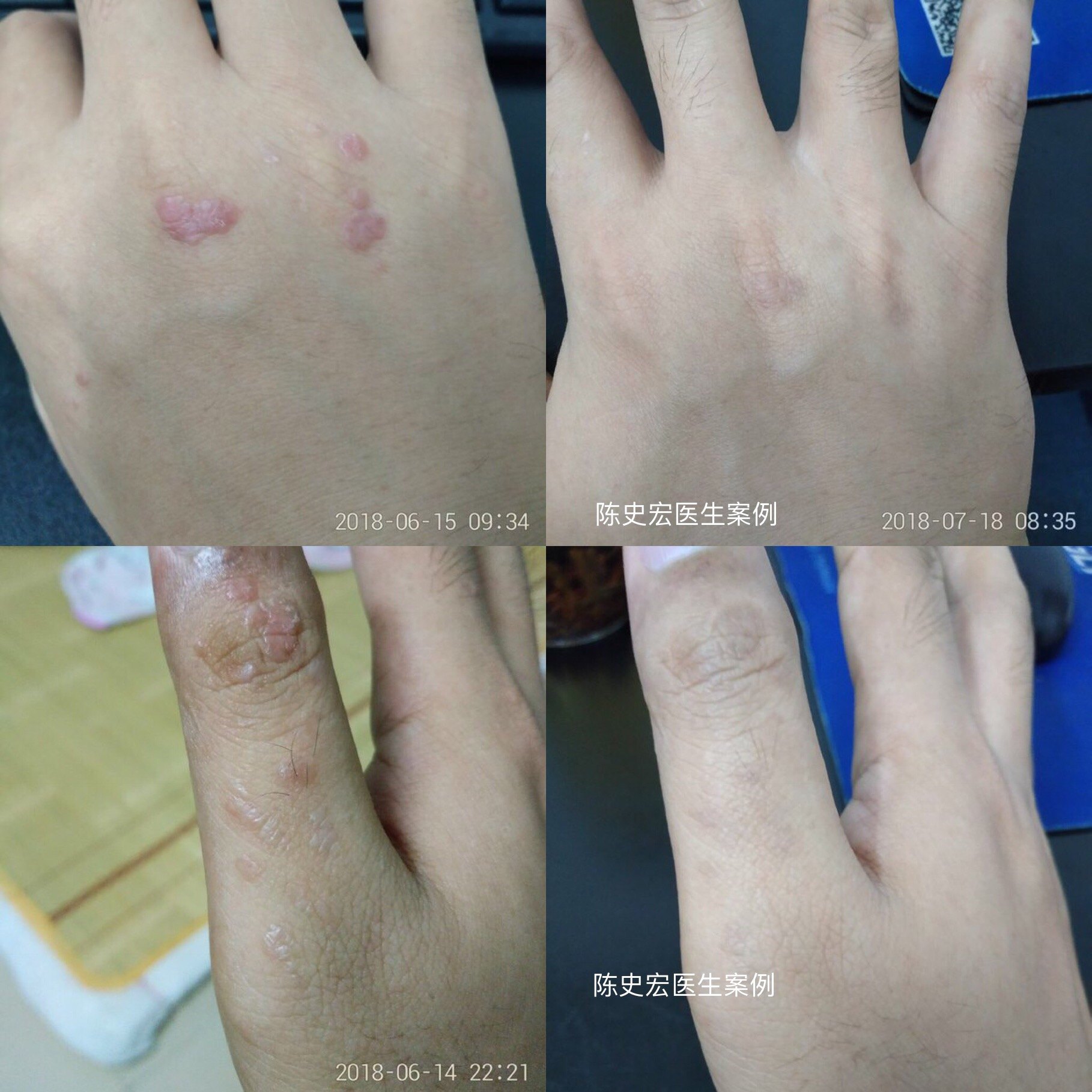 疣 疣 疾病介绍 病因 检查 治疗方法 用药 疣 疣 疾病介绍 病因 检查 治疗方法 用药