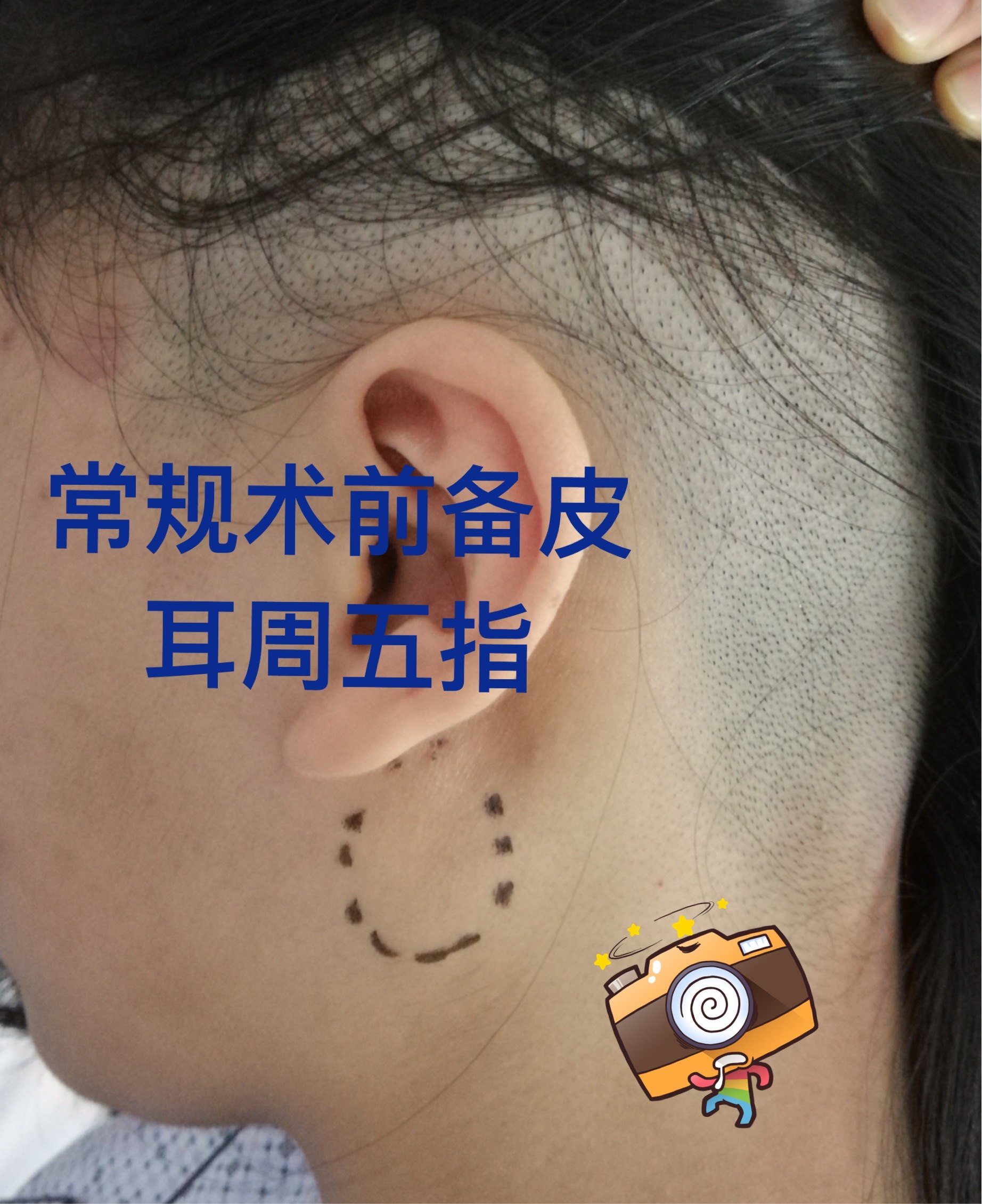 腮腺手术,我们更精致! - 好大夫在线