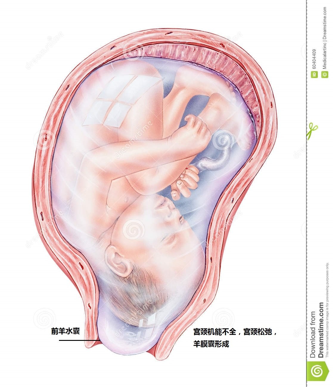 孕周破水 宫颈机能不全还是子宫肌瘤原因 流产 流产病因