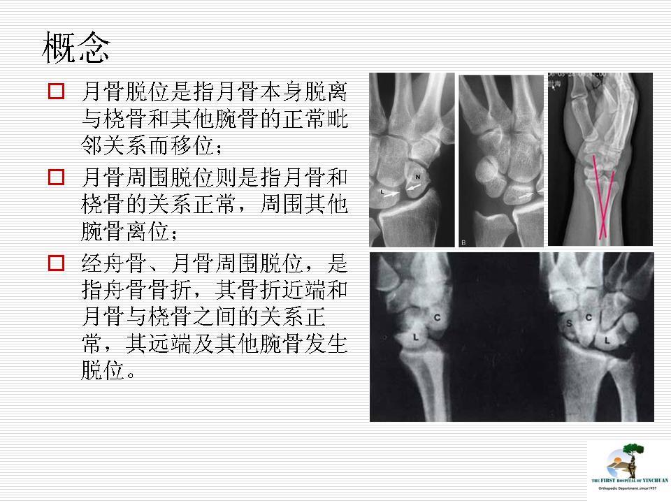 月骨周围脱位图片