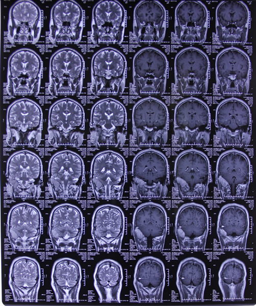 罕见浆细胞瘤多方求医无果,唐都神外贾栋主任行高难度手术治 - 好大夫