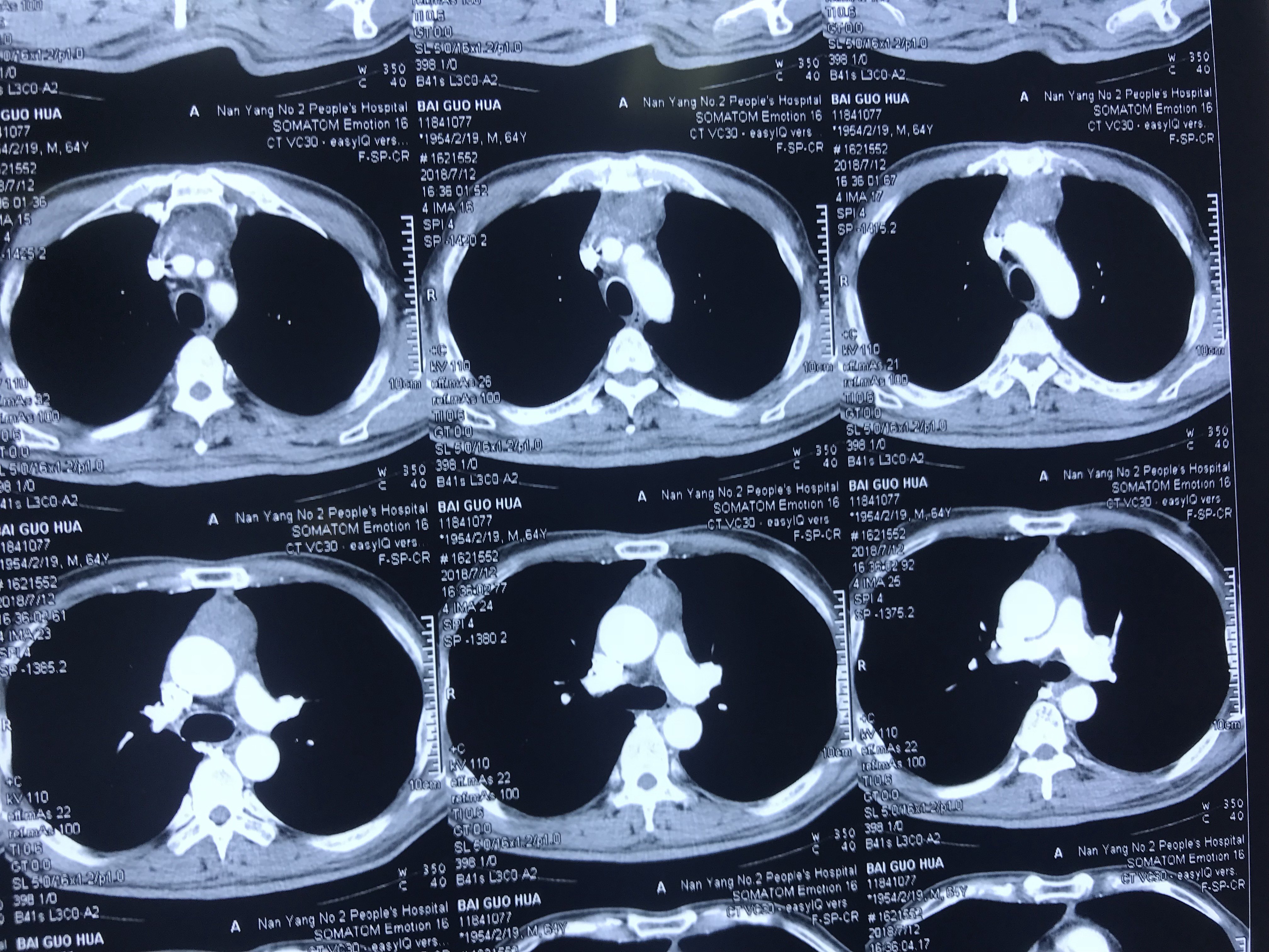 胸腺瘤的ct图片图片