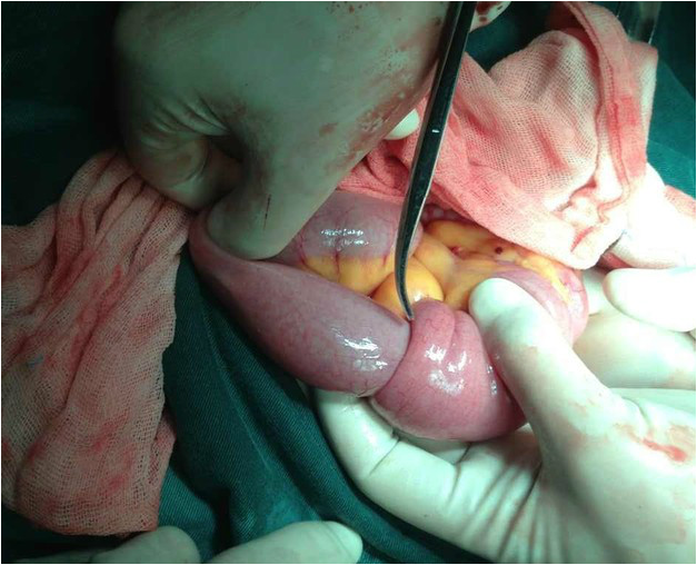 肠套叠的识别与处理 - 好大夫在线