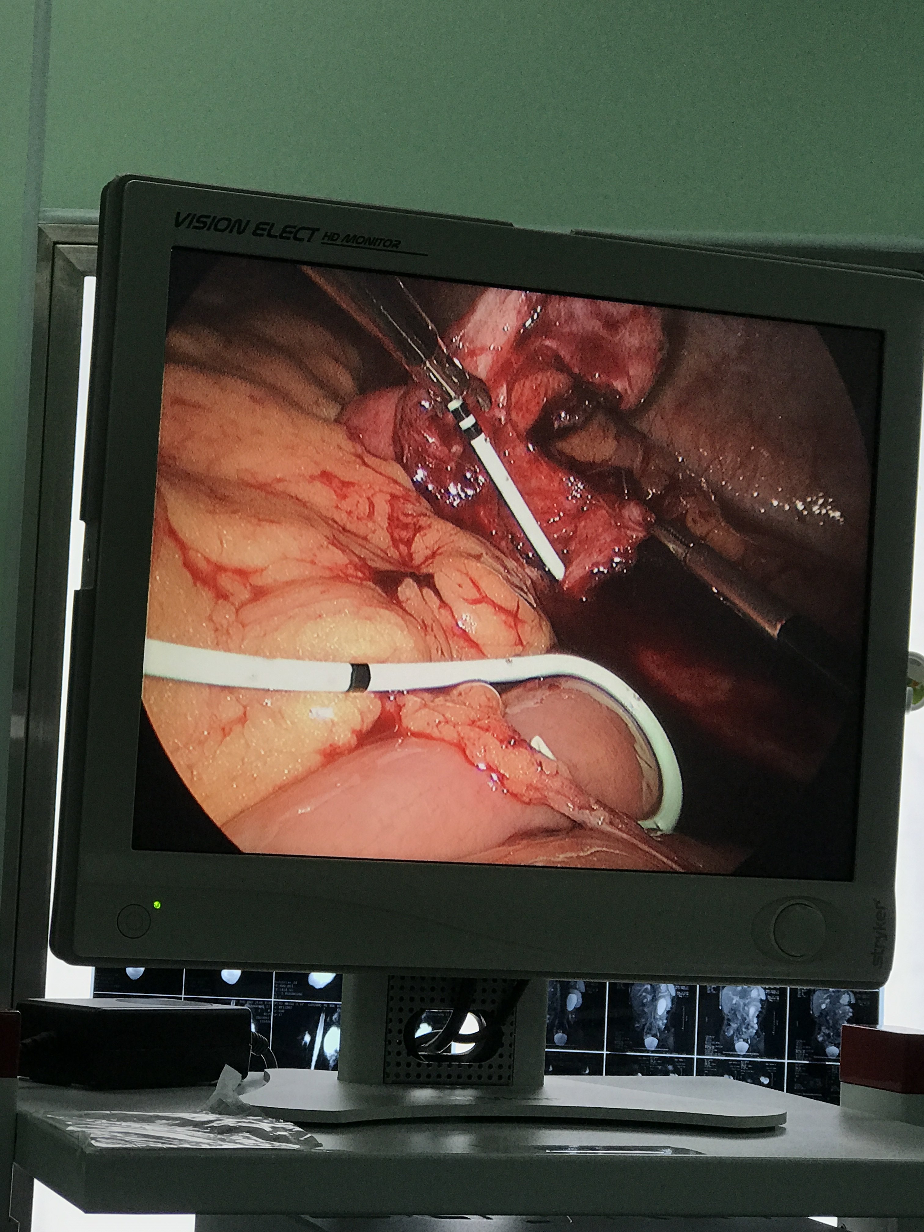 先天性肾积水腹腔镜下离断式肾盂成形微创手术 