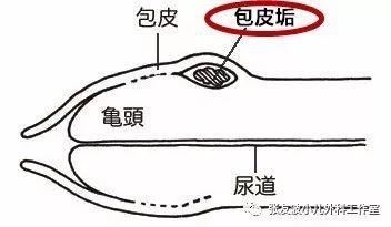 小儿外生殖器疾病之“包皮垢”_包皮过长_包皮过长疾病介绍 - 好大夫在线