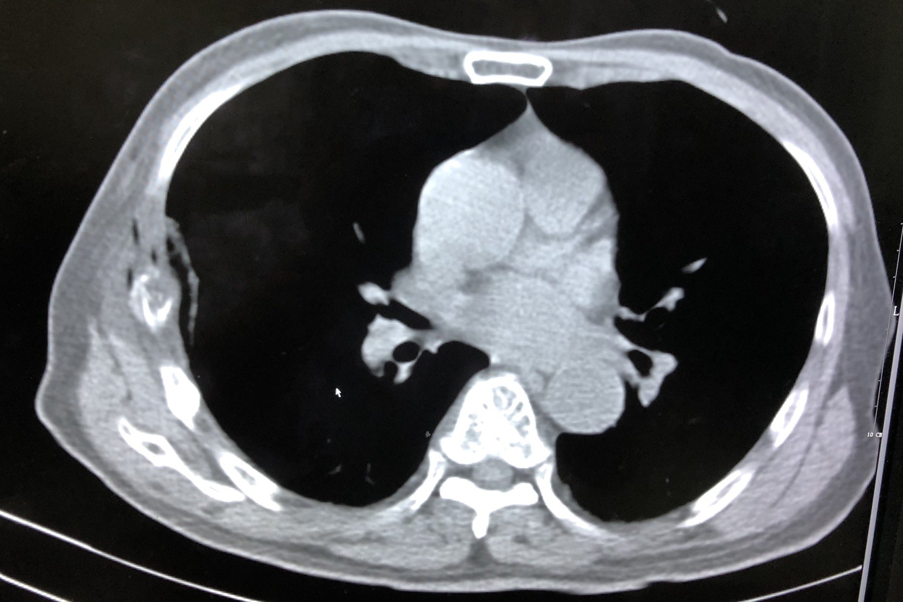 术前ct可见肋骨破坏,患者局部疼痛明显.